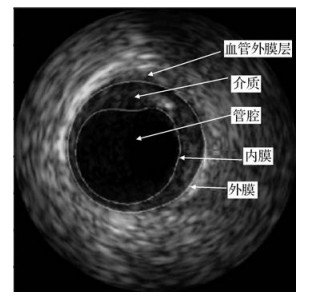 结合极值区域检测的血管内超声图像并行分割