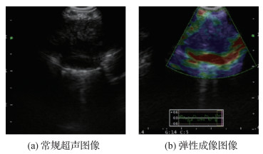 U-Net支气管超声弹性图像纵膈淋巴结分割